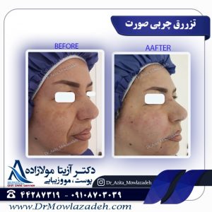 مزایای تزریق چربی