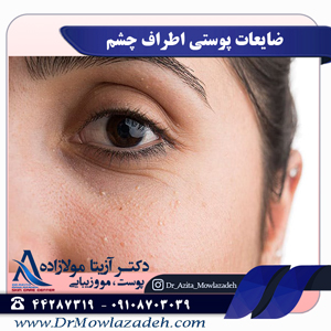 ضایعات پوستی اطراف چشم