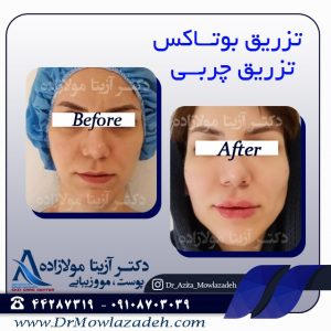 تزریق بوتاکس صورت