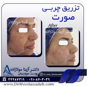 تزریق چربی