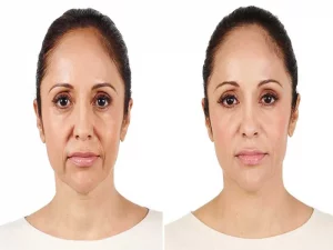 تزریق فیلر برای خط خنده