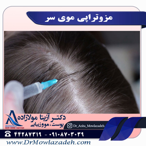 مزوتراپی موی سر