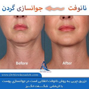 راههای جوانسازی گردن با نانو فت