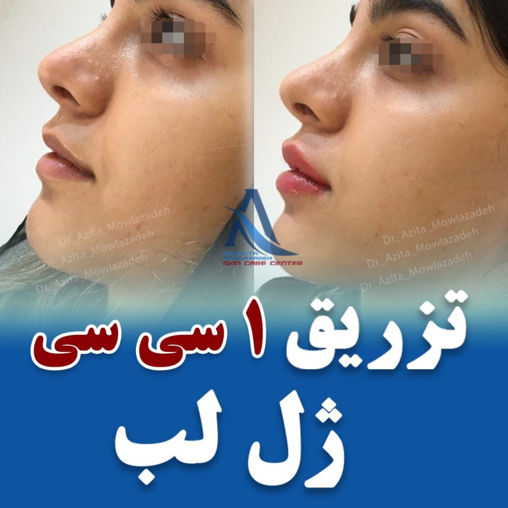 تزریق ژل لب فرم دهی لب با تزریق ژل تزریق ژل لب مدل نچرال قیمت تزریق ژل لب 6547