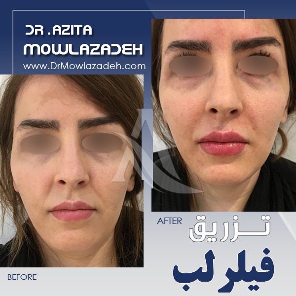 فیلر-لب