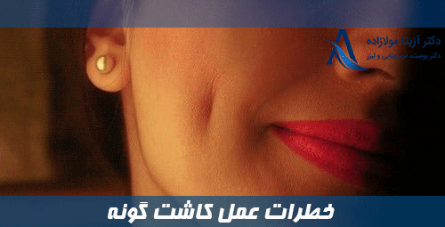 خطرات عمل کاشت گونه