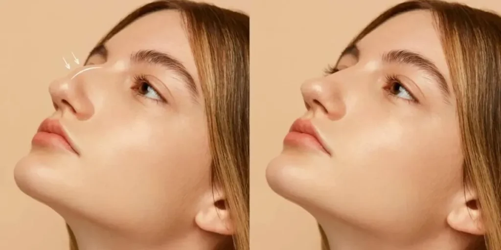 تزریق فیلر بینی
