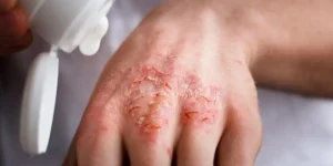 اگزما پوستی