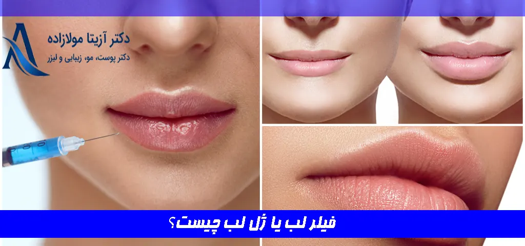 فیلر لب یا ژل لب چیست؟