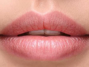 تکنیک تزریق ژل لب مدل روسی