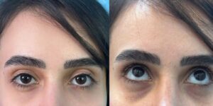 مراقبت های بعد از تزریق فیلر زیر چشم