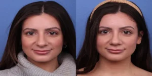 تخلیه چربی زیر پوست بینی