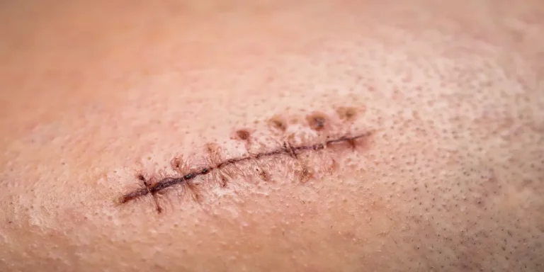 درم ابریژن برای جای بخیه