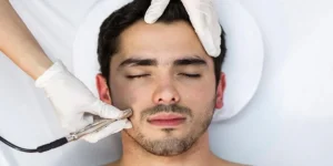 سوختگی بعد از میکرونیدلینگ