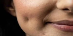ماندگاری جراحی چال گونه