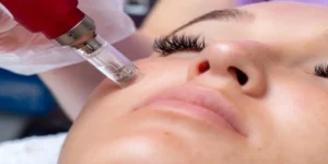 تاثیر میکرونیدلینگ بعد از چند روز است