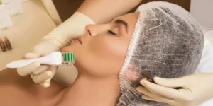 میکرونیدلینگ برای جوش سر سیاه