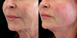 اندولیفت گردن