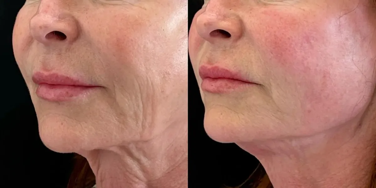 اندولیفت گردن