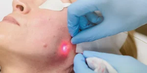 آندولیفت صورت