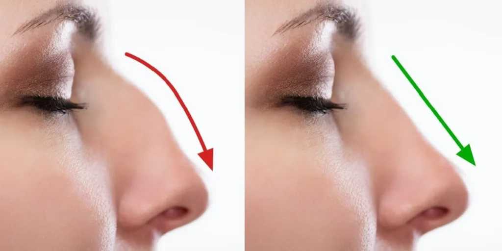 بهترین مرکز فیلر بینی در تهران