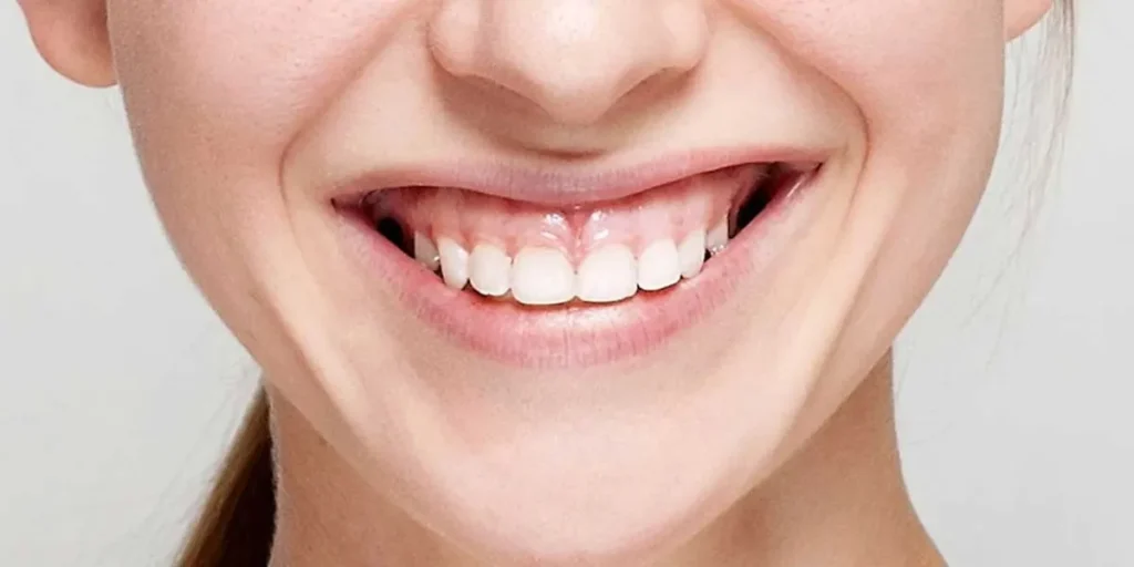 ماندگاری بوتاکس لبخند لثه ای