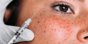 تزریق فیلر جای جوش؛ مزایا، نحوه انجام و نتایج