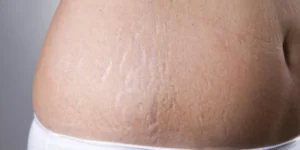 علت ایجاد استرچ مارک چیست؟ | هزینه درمان ترک پوستی