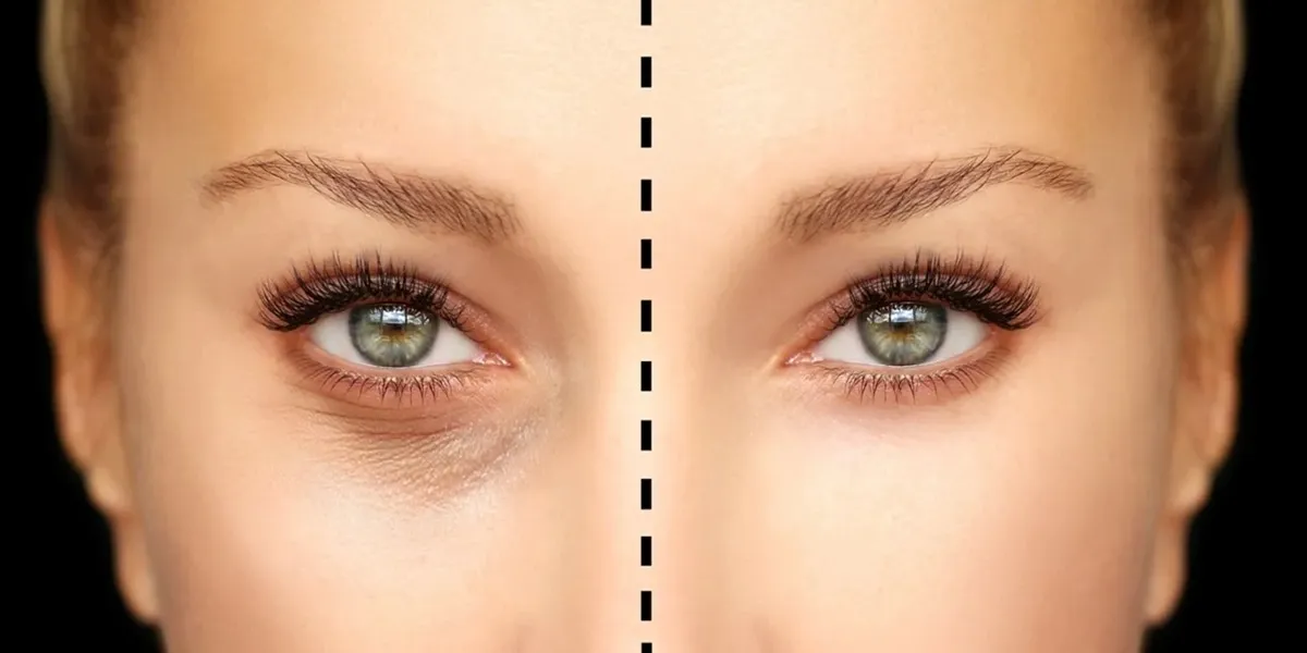 افتادگی پلک بعد از بوتاکس