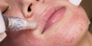 بهترین کلینیک تخصصی میکرونیدلینگ در غرب تهران