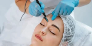 متخصص برداشتن خال