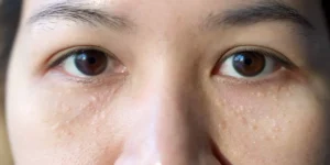 سیرنگوما چیست