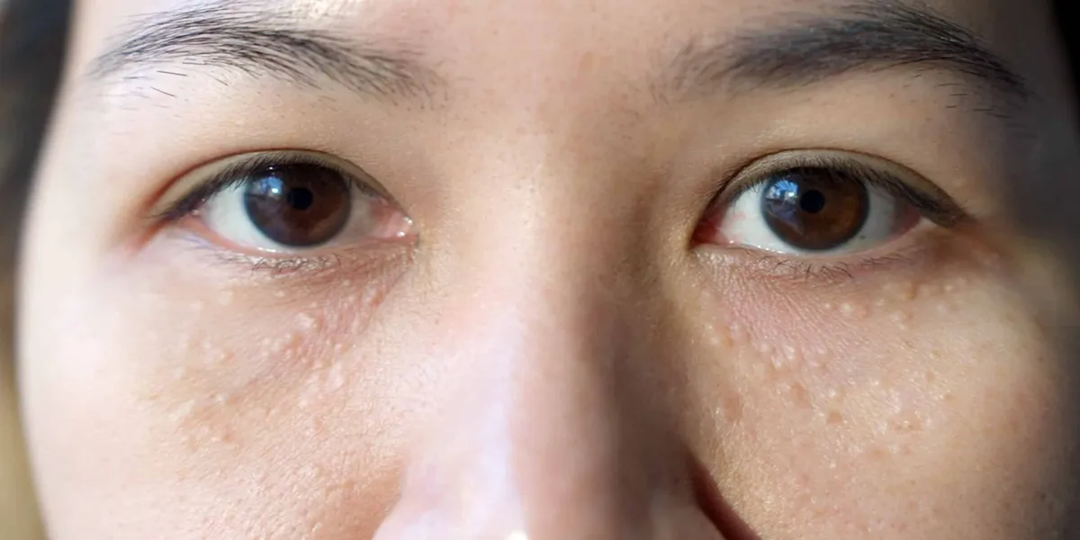 سیرنگوما چیست