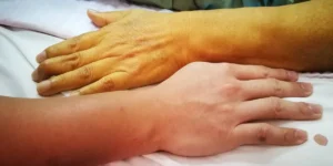 زرد زخم چیست؛ علائم، علل و روشهای درمان