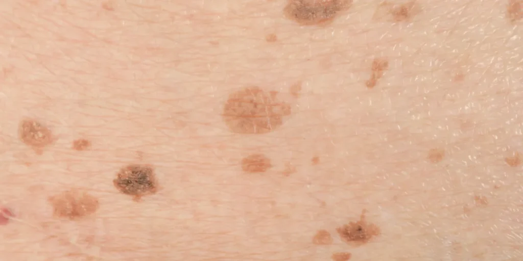 لنتیگو چیست و چگونه درمان می شود؟