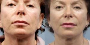 لیزر اربیوم