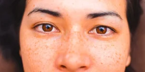 لنتیگو چیست و چگونه درمان می شود؟