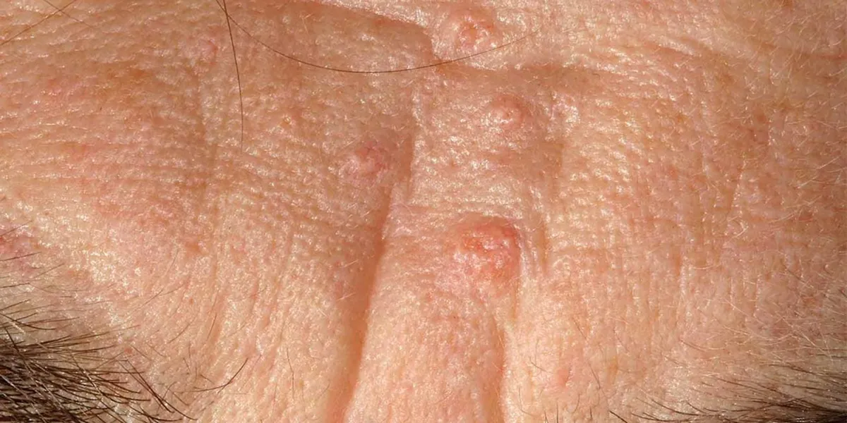 هیپرپلازی سباسه