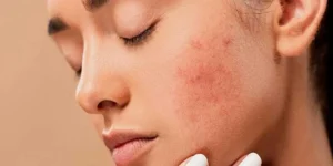 درمان روزاسه با لیزر